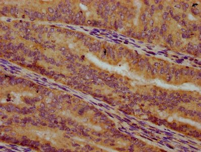 ALG10 / KCR1 Antibody - Immunohistochemistry Dilution at 1:300 and staining in paraffin-embedded human endometrial cancer performed on a Leica BondTM system. After dewaxing and hydration, antigen retrieval was mediated by high pressure in a citrate buffer (pH 6.0). Section was blocked with 10% normal Goat serum 30min at RT. Then primary antibody (1% BSA) was incubated at 4°C overnight. The primary is detected by a biotinylated Secondary antibody and visualized using an HRP conjugated SP system.