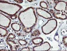 ALG2 Antibody - IHC of paraffin-embedded Carcinoma of Human thyroid tissue using anti-ALG2 mouse monoclonal antibody.