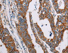 ALG2 Antibody - Immunohistochemistry of paraffin-embedded Human lung cancer using ALG2 Polyclonal Antibody at dilution of 1:35.