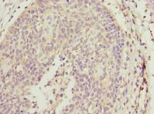 ALG2 Antibody - Immunohistochemistry of paraffin-embedded human cervical cancer at dilution 1:100
