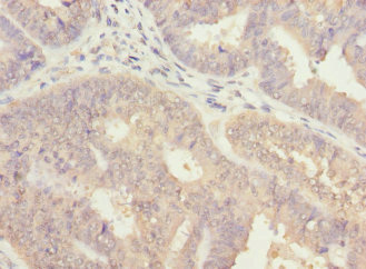ALG2 Antibody - Immunohistochemistry of paraffin-embedded human endometrial cancer at dilution 1:100