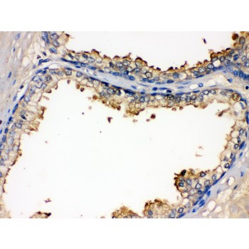 ALK-6 / BMPR1B Antibody - BMPR1B antibody IHC-paraffin. IHC(P): Human Prostatic Cancer Tissue.
