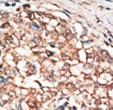 ALK-6 / BMPR1B Antibody - Formalin-fixed and paraffin-embedded human cancer tissue reacted with the primary antibody, which was peroxidase-conjugated to the secondary antibody, followed by DAB staining. This data demonstrates the use of this antibody for immunohistochemistry; clinical relevance has not been evaluated. BC = breast carcinoma; HC = hepatocarcinoma.