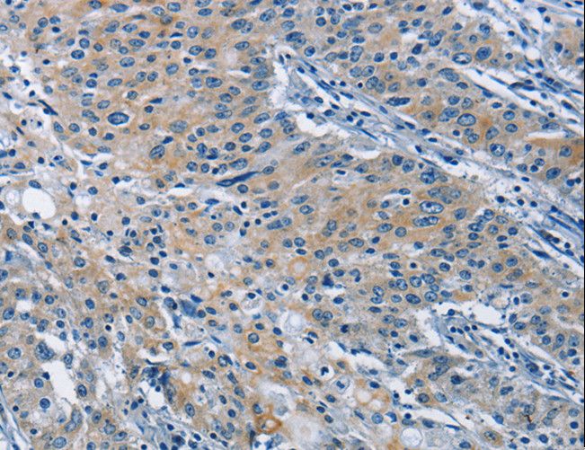 ALK-6 / BMPR1B Antibody - Immunohistochemistry of paraffin-embedded Human gastric cancer using BMPR1B Polyclonal Antibody at dilution of 1:30.