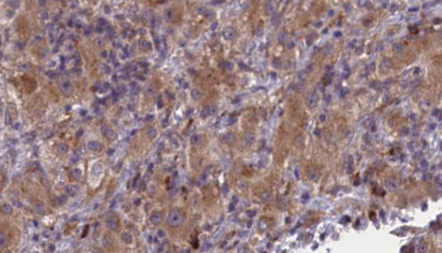 ALK-6 / BMPR1B Antibody - 1:100 staining human liver carcinoma tissues by IHC-P. The sample was formaldehyde fixed and a heat mediated antigen retrieval step in citrate buffer was performed. The sample was then blocked and incubated with the antibody for 1.5 hours at 22°C. An HRP conjugated goat anti-rabbit antibody was used as the secondary.