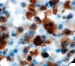 ALK Antibody - IHC of ALK-1 on FFPE Anaplastic Large Cell Lymphoma tissue.