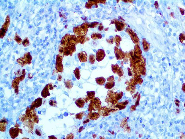 ALK Antibody - IHC of ALK/CD246 on a FFPE Anaplastic Large Cell Lymphoma Tissue