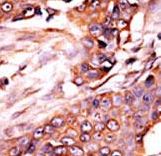 ALK2 / ACVR1 Antibody - Formalin-fixed and paraffin-embedded human cancer tissue reacted with the primary antibody, which was peroxidase-conjugated to the secondary antibody, followed by AEC staining. This data demonstrates the use of this antibody for immunohistochemistry; clinical relevance has not been evaluated. BC = breast carcinoma;