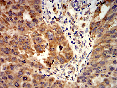 ALK2 / ACVR1 Antibody - Immunohistochemical analysis of paraffin-embedded ovarian cancer tissues using ACVR1 mouse mAb with DAB staining.