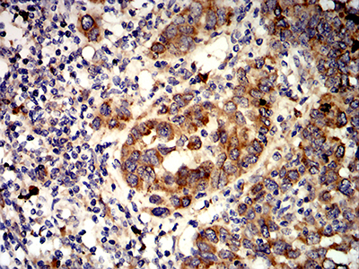ALK2 / ACVR1 Antibody - Immunohistochemical analysis of paraffin-embedded endometrial cancer tissues using ACVR1 mouse mAb with DAB staining.