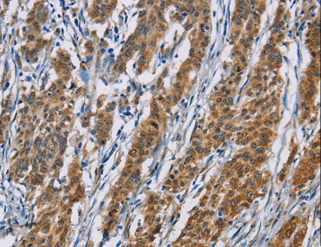 ALK2 / ACVR1 Antibody - Immunohistochemistry of paraffin-embedded Human thyroid cancer using ACVR1 Polyclonal Antibody at dilution of 1:60.