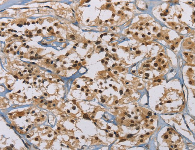 ALK2 / ACVR1 Antibody - Immunohistochemistry of paraffin-embedded Human thyroid cancer using ACVR1 Polyclonal Antibody at dilution of 1:60.