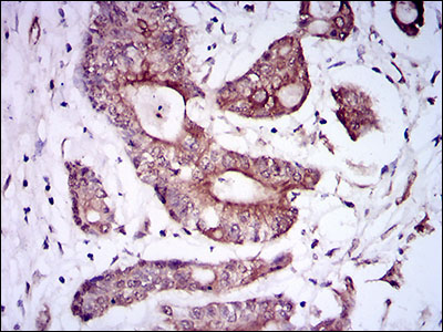ALK3 / BMPR1A Antibody - IHC of paraffin-embedded colon cancer tissues using BMPR1A mouse monoclonal antibody with DAB staining.