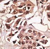 ALK3 / BMPR1A Antibody - Formalin-fixed and paraffin-embedded human cancer tissue reacted with the primary antibody, which was peroxidase-conjugated to the secondary antibody, followed by DAB staining. This data demonstrates the use of this antibody for immunohistochemistry; clinical relevance has not been evaluated. BC = breast carcinoma; HC = hepatocarcinoma.