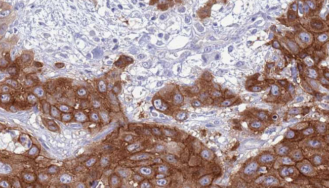 ALK3 / BMPR1A Antibody - 1:100 staining human Head and neck carcinoma tissue by IHC-P. The sample was formaldehyde fixed and a heat mediated antigen retrieval step in citrate buffer was performed. The sample was then blocked and incubated with the antibody for 1.5 hours at 22°C. An HRP conjugated goat anti-rabbit antibody was used as the secondary.