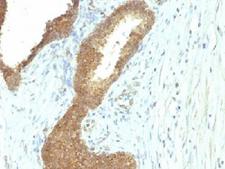 Alkaline Phosphatase Antibody - IHC testing of FFPE human colon carcinoma with Alkaline Phosphatase antibody (ALPL/597). Required HIER: boil tissue sections in 10mM Tris with 1mM EDTA, pH 9, for 10-20 min followed by cooling at RT for 20 min.
