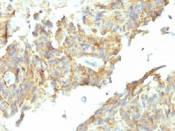 Alkaline Phosphatase Antibody - IHC testing of FFPE human ovarian carcinoma with Alkaline Phosphatase antibody (ALPL/597). Required HIER: boil tissue sections in 10mM Tris with 1mM EDTA, pH 9, for 10-20 min followed by cooling at RT for 20 min.