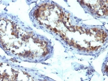 Alkaline Phosphatase Antibody - IHC testing of FFPE human testicular carcinoma with Alkaline Phosphatase antibody (ALPL/597). Required HIER: boil tissue sections in 10mM Tris with 1mM EDTA, pH 9, for 10-20 min followed by cooling at RT for 20 min.