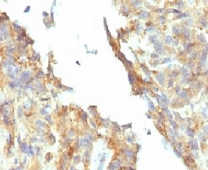 Alkaline Phosphatase Antibody - IHC testing of FFPE ovarian carcinoma and Alkaline Phosphatase antibody (KSUL-1). Required HIER: boil tissue sections in 10mM Tris with 1mM EDTA, pH 9, for 10-20 min followed by cooling at RT for 20 min.