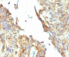 Alkaline Phosphatase Antibody - IHC testing of FFPE ovarian carcinoma and Alkaline Phosphatase antibody (KSUL-1). Required HIER: boil tissue sections in 10mM Tris with 1mM EDTA, pH 9, for 10-20 min followed by cooling at RT for 20 min.