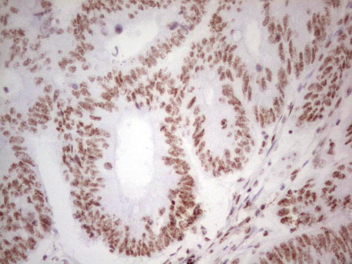 ALKBH1 / ALKB Antibody - IHC of paraffin-embedded Adenocarcinoma of Human colon tissue using anti-ALKBH1 mouse monoclonal antibody. (Heat-induced epitope retrieval by 1 mM EDTA in 10mM Tris, pH8.5, 120°C for 3min).