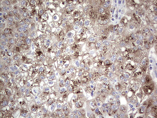 ALKBH1 / ALKB Antibody - Immunohistochemical staining of paraffin-embedded Carcinoma of Human lung tissue using anti-ALKBH1 mouse monoclonal antibody. (Heat-induced epitope retrieval by 1 mM EDTA in 10mM Tris, pH8.5, 120C for 3min,