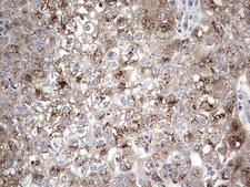 ALKBH1 / ALKB Antibody - Immunohistochemical staining of paraffin-embedded Carcinoma of Human lung tissue using anti-ALKBH1 mouse monoclonal antibody. (Heat-induced epitope retrieval by 1 mM EDTA in 10mM Tris, pH8.5, 120C for 3min,