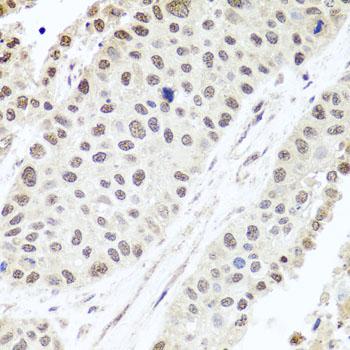 ALKBH4 Antibody - Immunohistochemistry of paraffin-embedded Human lung cancer using ALKBH4 Polyclonal Antibody at dilution of 1:100 (40x lens).