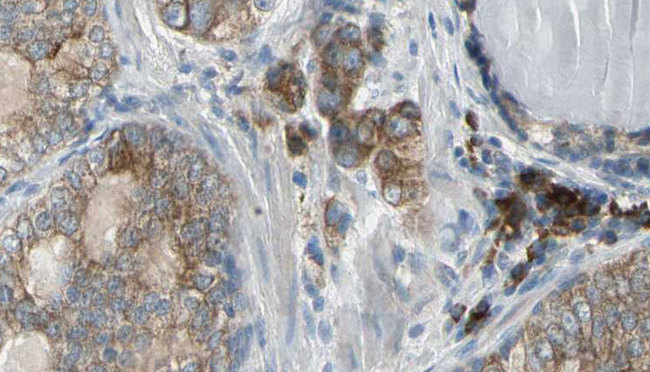 ALKBH7 Antibody - 1:100 staining human prostate tissue by IHC-P. The sample was formaldehyde fixed and a heat mediated antigen retrieval step in citrate buffer was performed. The sample was then blocked and incubated with the antibody for 1.5 hours at 22°C. An HRP conjugated goat anti-rabbit antibody was used as the secondary.