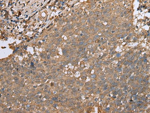ALKBH8 Antibody - Immunohistochemistry of paraffin-embedded Human cervical cancer tissue  using ALKBH8 Polyclonal Antibody at dilution of 1:25(×200)