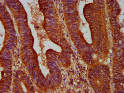 ALOX12 / 12 Lipoxygenase Antibody - Immunohistochemistry Dilution at 1:500 and staining in paraffin-embedded human colon cancer performed on a Leica BondTM system. After dewaxing and hydration, antigen retrieval was mediated by high pressure in a citrate buffer (pH 6.0). Section was blocked with 10% normal Goat serum 30min at RT. Then primary antibody (1% BSA) was incubated at 4°C overnight. The primary is detected by a biotinylated Secondary antibody and visualized using an HRP conjugated SP system.