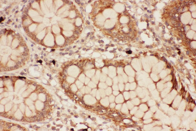 ALOX15 / 15-Lipoxygenase Antibody - ALOX15 antibody IHC-paraffin: Human Intestine Cancer Tissue.
