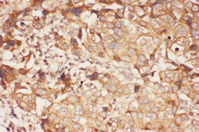 ALOX15 / 15-Lipoxygenase Antibody - ALOX15 antibody IHC-paraffin: Human Mammary Cancer Tissue.