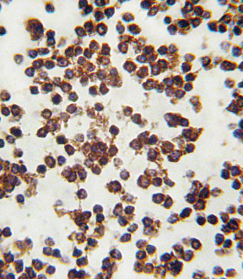 ALOX15 / 15-Lipoxygenase Antibody - Formalin-fixed and paraffin-embedded human lymph tissue reacted with ALOX15 antibody , which was peroxidase-conjugated to the secondary antibody, followed by DAB staining. This data demonstrates the use of this antibody for immunohistochemistry; clinical relevance has not been evaluated.