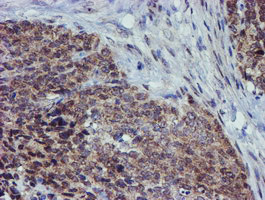 ALOX15 / 15-Lipoxygenase Antibody - IHC of paraffin-embedded Adenocarcinoma of Human breast tissue using anti-ALOX15 mouse monoclonal antibody.