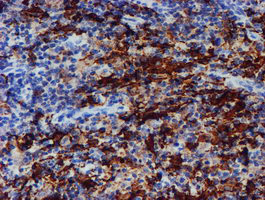 ALOX15 / 15-Lipoxygenase Antibody - IHC of paraffin-embedded Human lymphoma tissue using anti-ALOX15 mouse monoclonal antibody.