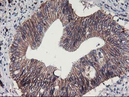 ALOX15 / 15-Lipoxygenase Antibody - IHC of paraffin-embedded Carcinoma of Human pancreas tissue using anti-ALOX15 mouse monoclonal antibody.