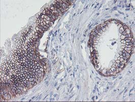 ALOX15 / 15-Lipoxygenase Antibody - IHC of paraffin-embedded Carcinoma of Human prostate tissue using anti-ALOX15 mouse monoclonal antibody.
