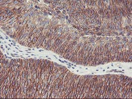 ALOX15 / 15-Lipoxygenase Antibody - IHC of paraffin-embedded Carcinoma of Human bladder tissue using anti-ALOX15 mouse monoclonal antibody.