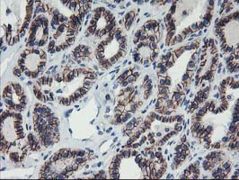 ALOX15 / 15-Lipoxygenase Antibody - IHC of paraffin-embedded Carcinoma of Human thyroid tissue using anti-ALOX15 mouse monoclonal antibody.