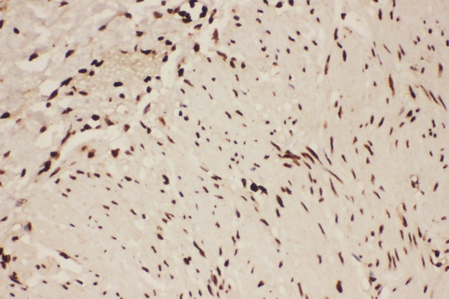 ALOX5 / 5-LOX Antibody - ALOX5 antibody IHC-paraffin: Human Intestinal Cancer Tissue.