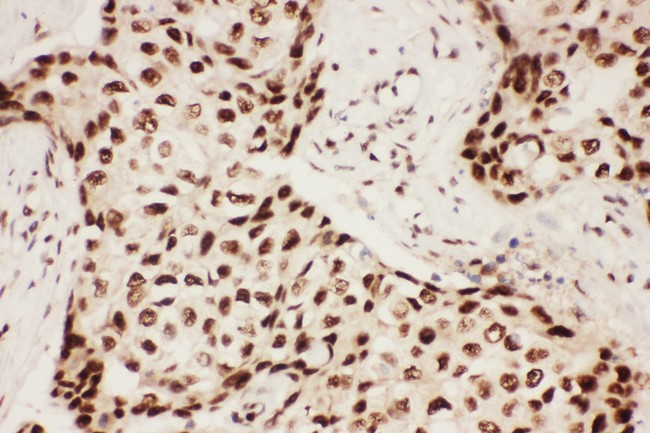 ALOX5 / 5-LOX Antibody - ALOX5 antibody IHC-paraffin: Human Mammary Cancer Tissue.