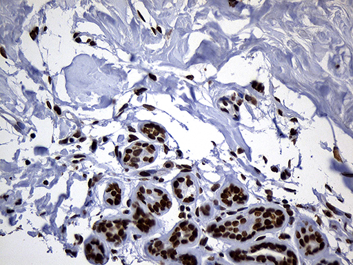 ALOX5 / 5-LOX Antibody - Immunohistochemical staining of paraffin-embedded Human breast tissue within the normal limits using anti-ALOX5 mouse monoclonal antibody. (Heat-induced epitope retrieval by 1mM EDTA in 10mM Tris buffer. (pH8.5) at 120°C for 3 min. (1:500)