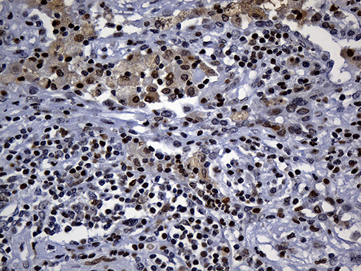 ALOX5 / 5-LOX Antibody - Immunohistochemical staining of paraffin-embedded Carcinoma of Human lung tissue using anti-ALOX5 mouse monoclonal antibody. (Heat-induced epitope retrieval by 1mM EDTA in 10mM Tris buffer. (pH8.5) at 120°C for 3 min. (1:500)