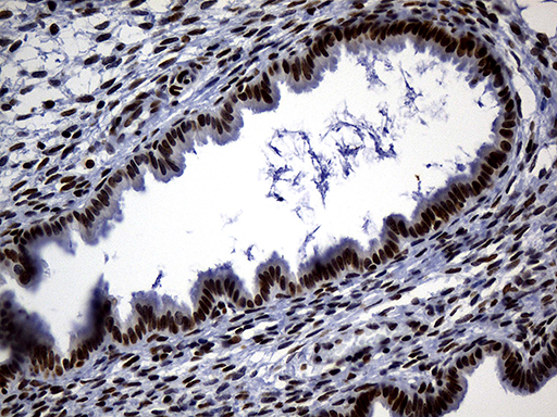 ALOX5 / 5-LOX Antibody - Immunohistochemical staining of paraffin-embedded Human endometrium tissue within the normal limits using anti-ALOX5 mouse monoclonal antibody. (Heat-induced epitope retrieval by 1mM EDTA in 10mM Tris buffer. (pH8.5) at 120°C for 3 min. (1:500)