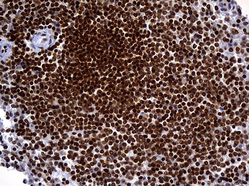 ALOX5 / 5-LOX Antibody - Immunohistochemical staining of paraffin-embedded Human lymphoma tissue using anti-ALOX5 mouse monoclonal antibody. (Heat-induced epitope retrieval by 1mM EDTA in 10mM Tris buffer. (pH8.5) at 120°C for 3 min. (1:500)