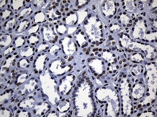 ALOX5 / 5-LOX Antibody - Immunohistochemical staining of paraffin-embedded Human Kidney tissue within the normal limits using anti-ALOX5 mouse monoclonal antibody. (Heat-induced epitope retrieval by 1mM EDTA in 10mM Tris buffer. (pH8.5) at 120°C for 3 min. (1:500)