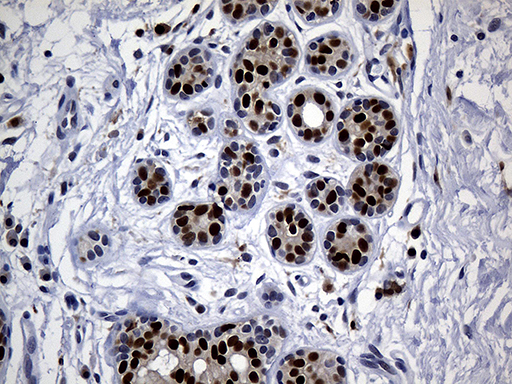 ALOX5 / 5-LOX Antibody - Immunohistochemical staining of paraffin-embedded Adenocarcinoma of Human breast tissue tissue using anti-ALOX5 mouse monoclonal antibody. (Heat-induced epitope retrieval by 1mM EDTA in 10mM Tris buffer. (pH8.5) at 120°C for 3 min. (1:2000)