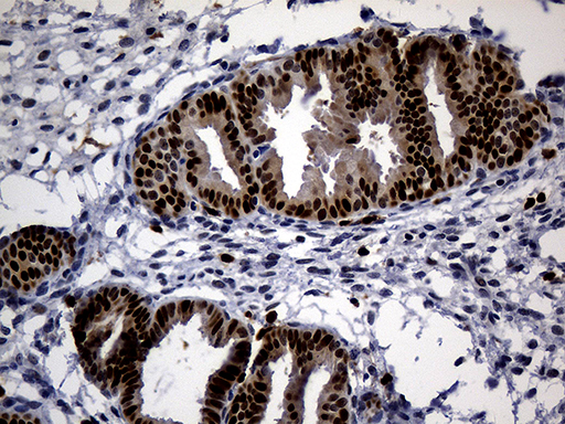 ALOX5 / 5-LOX Antibody - Immunohistochemical staining of paraffin-embedded Human endometrium tissue within the normal limits using anti-ALOX5 mouse monoclonal antibody. (Heat-induced epitope retrieval by 1mM EDTA in 10mM Tris buffer. (pH8.5) at 120°C for 3 min. (1:2000)