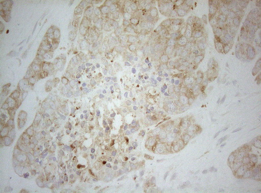 ALOX5 / 5-LOX Antibody - Immunohistochemical staining of paraffin-embedded Adenocarcinoma of Human endometrium tissue using anti-ALOX5 mouse monoclonal antibody. (Heat-induced epitope retrieval by 1mM EDTA in 10mM Tris buffer. (pH8.5) at 120°C for 3 min. (1:150)
